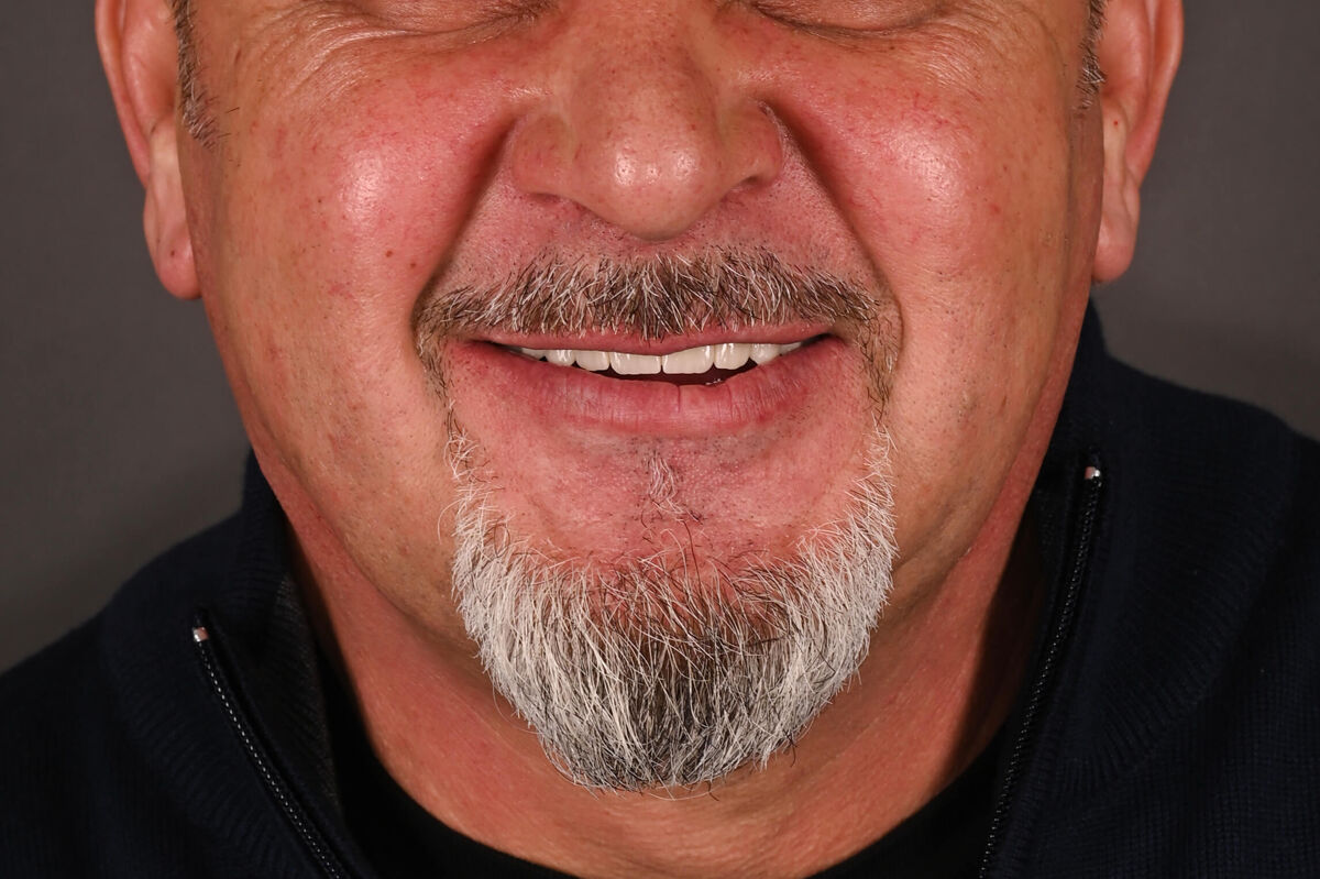 Zâmbet lateral stanga_dupa